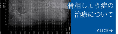 骨粗しょう症の治療について